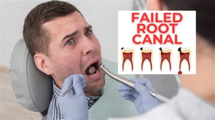 What happens if a root canal failed twice?