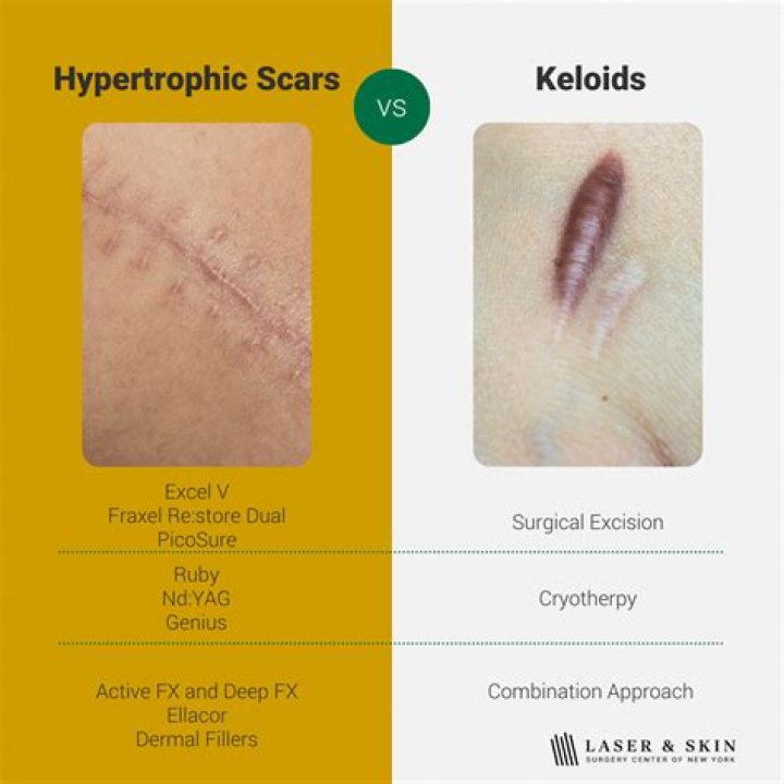 What helps pain after keloid removal?