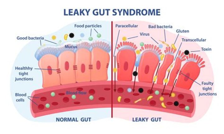 What is leaky gut?