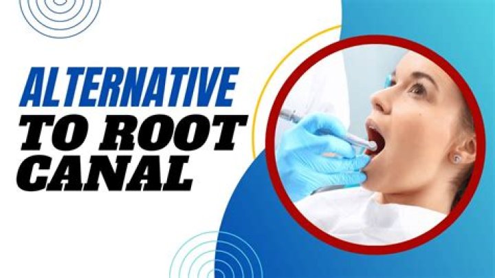 What is the alternative for root canal?