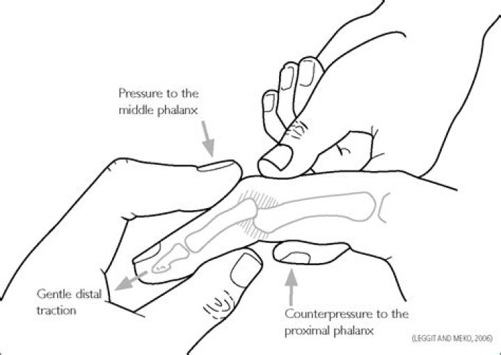 What is the fastest way to heal a dislocated finger?
