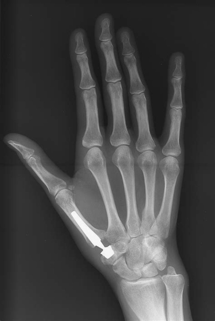 What is the most common complication with thumb arthroplasty?