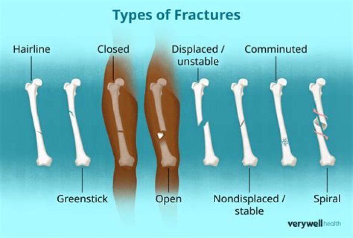 What types of fractures are most difficult to repair?