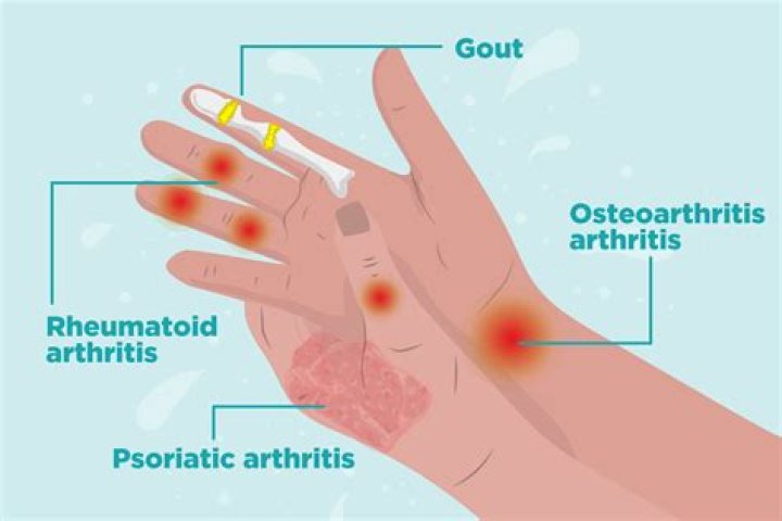Where does arthritis start in the hand?