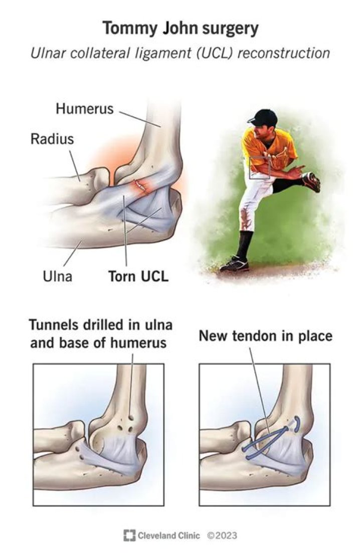 Where does Tommy elbow hurt?