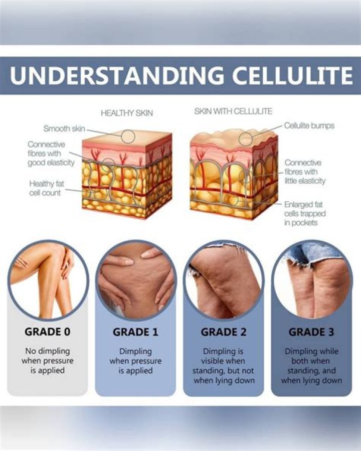 Why does cellulite look worse some days?