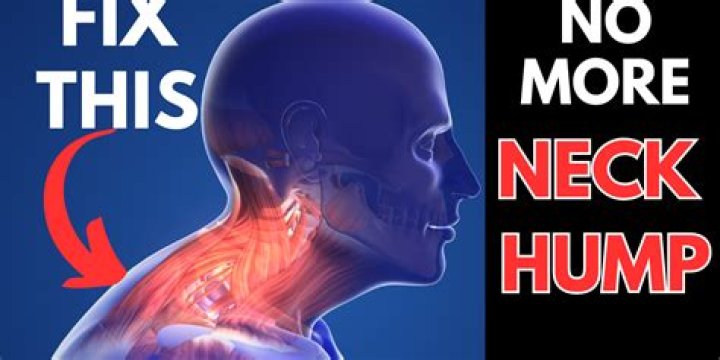 Why does my neck have a hump?