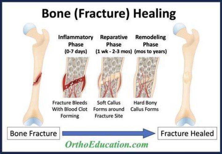 Why isn't my bone healing?
