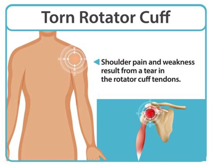 Will a cortisone shot help a torn rotator cuff?