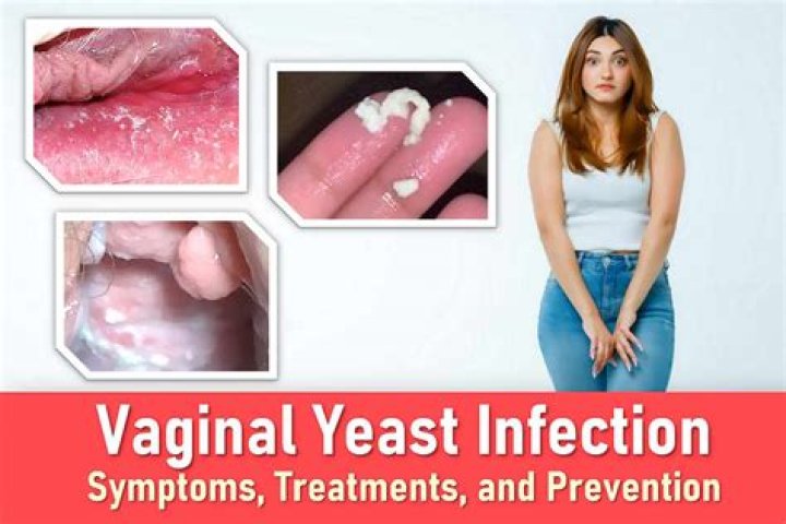 Will yeast infection go away?
